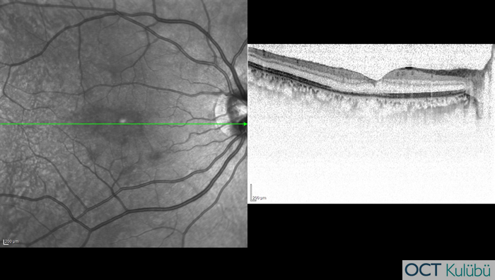 Akut Maküler Nöroretinopati Optik koherens tomografi