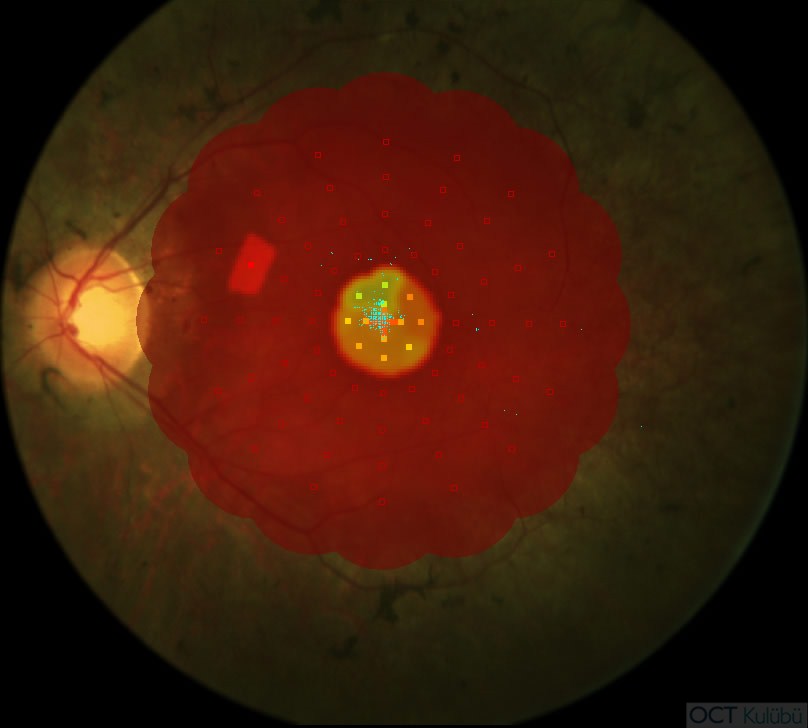 Mikroperimetri
Retinitis Pigmentosa