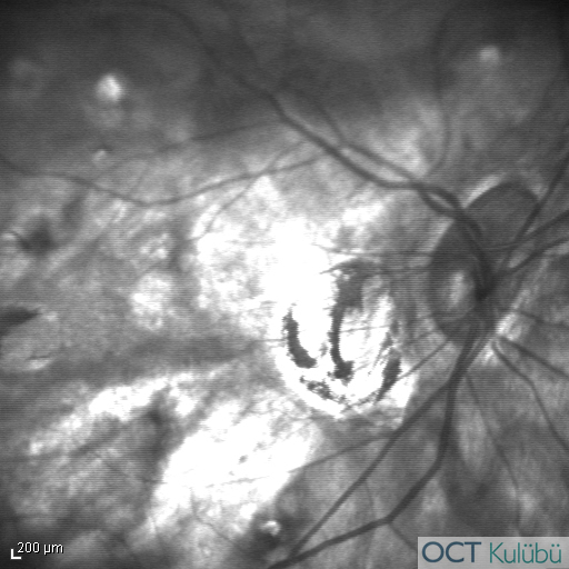 Miyopik Koroidal Neovaskülarizasyon