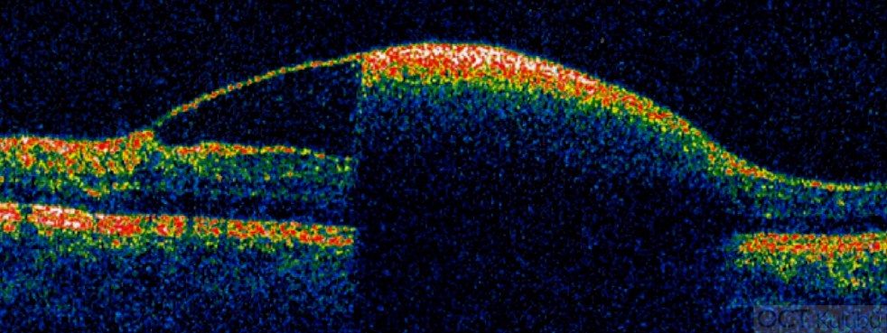 Valsalva Retinopati Sekeli OCT