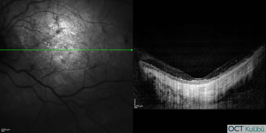 Bietti’nin Kristalin Distrofisi
Optik koherens tomografi (OCT) 