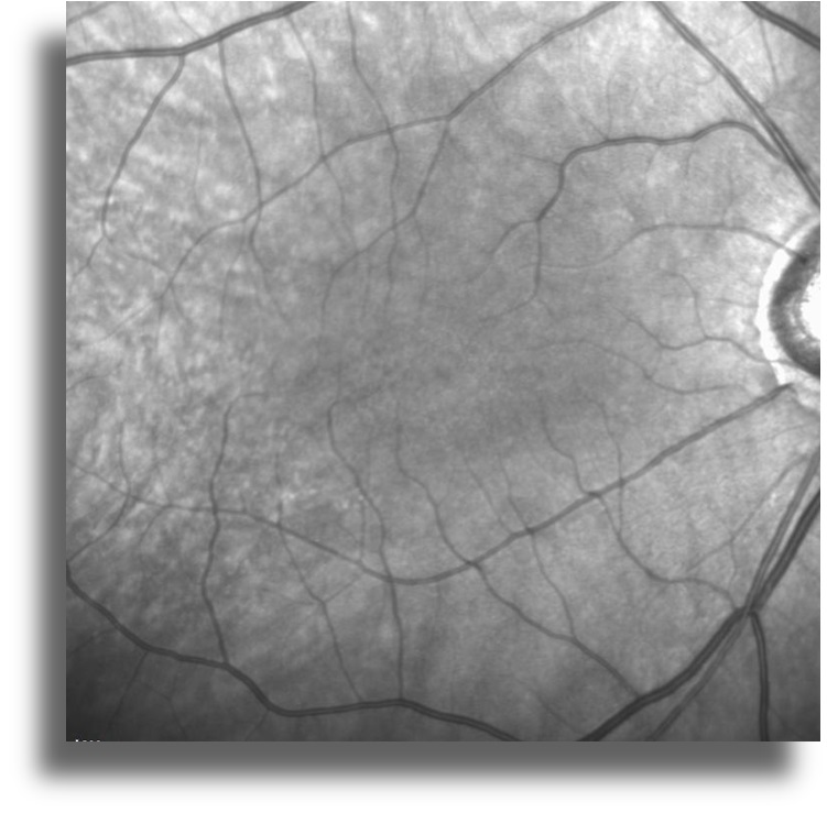 Non-Neoplastik Otoimmün Retinopati infrared reflektans