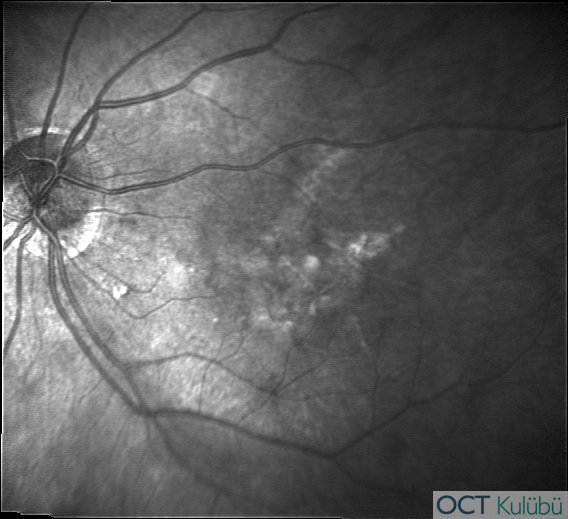 Miyopik Koroidal Neovaskülarizasyon