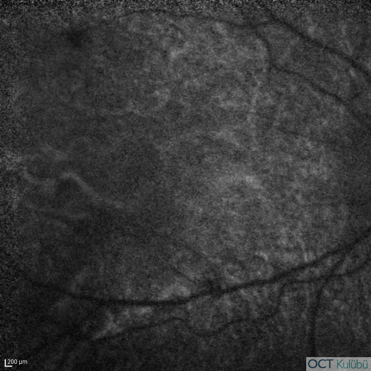 Bietti’nin Kristalin Distrofisi
Fundus otoflöresans