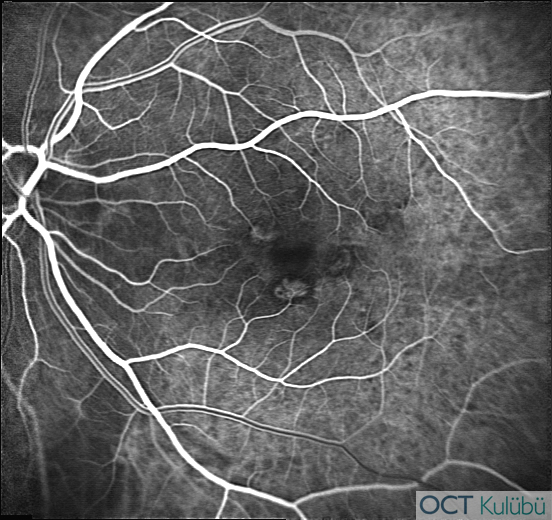 Miyopik Koroidal Neovaskülarizasyon Flöresein anjiografi (FA)