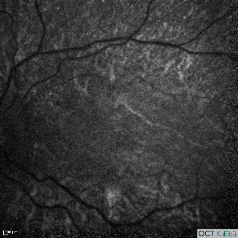 Bietti’nin Kristalin Distrofisi
Fundus otoflöresans