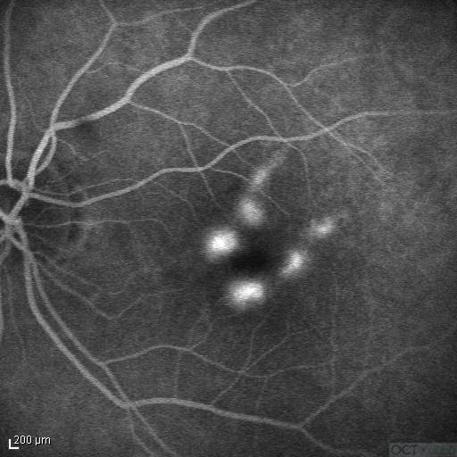 Miyopik Koroidal Neovaskülarizasyon Flöresein anjiografi (FA)