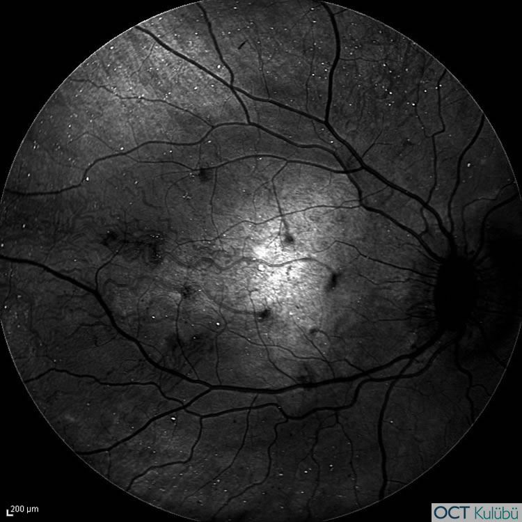 Bietti’nin Kristalin Distrofisi
infrared fundus görüntüleme