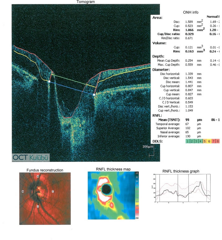 Optik Disk Druseni
Optik koherens tomografi (OCT) 
retina sinir lifi kalınlığı