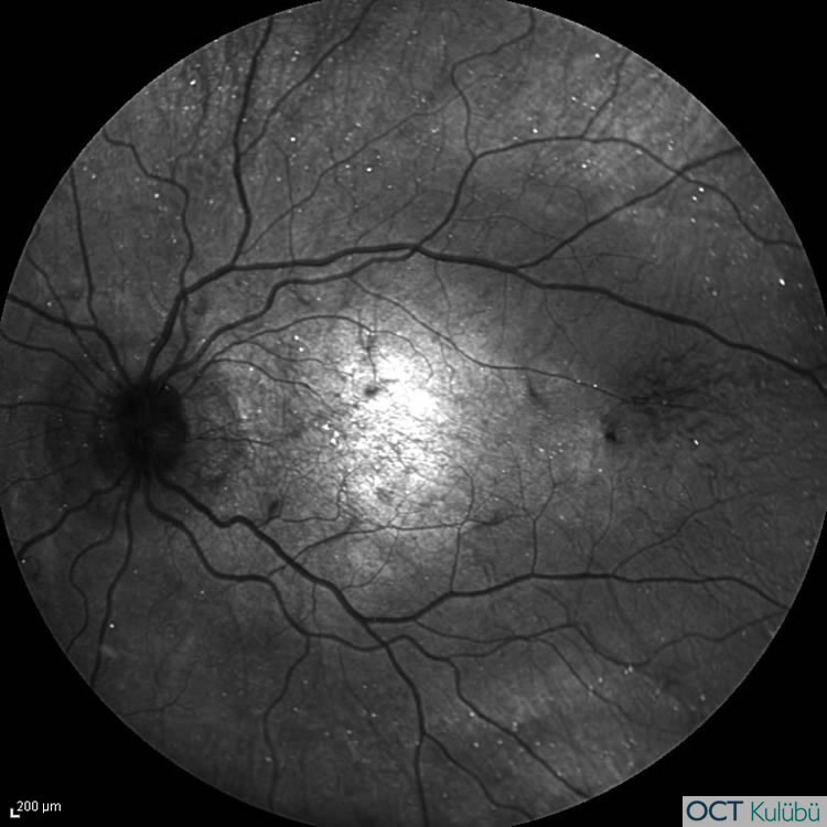 Bietti’nin Kristalin Distrofisi
 infrared fundus görüntüleme