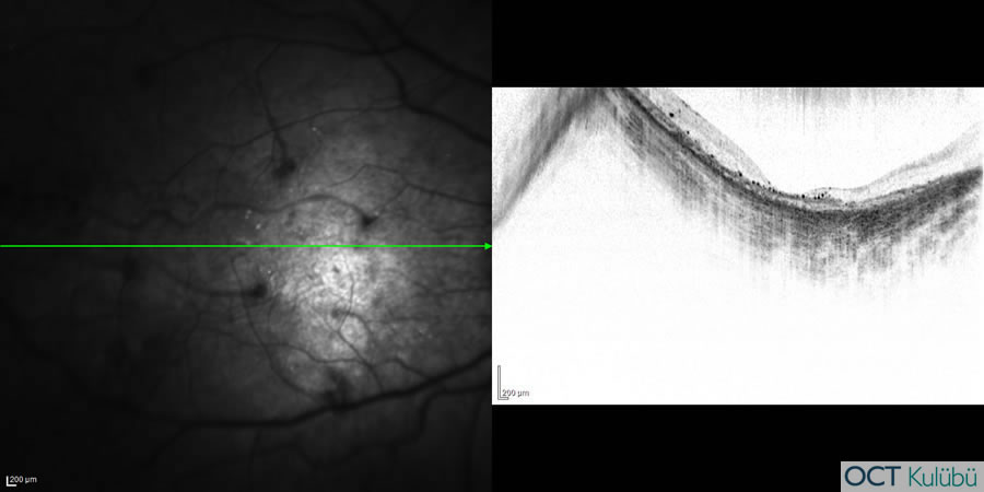 Bietti’nin Kristalin Distrofisi
Optik koherens tomografi (OCT) 