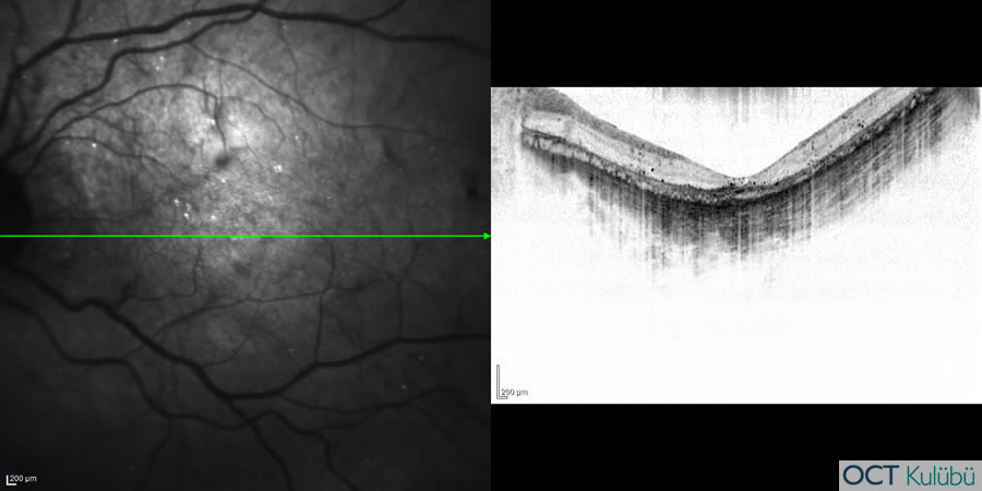 Bietti’nin Kristalin Distrofisi
Optik koherens tomografi (OCT) 