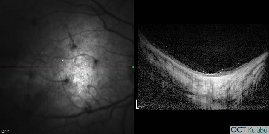 Bietti’nin Kristalin Distrofisi
Optik koherens tomografi (OCT) 