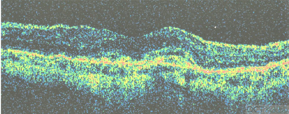 Miyopik Koroidal Neovaskülarizasyon 
Optik koherens tomografi (OCT)