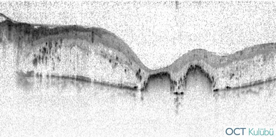 oct diabetik retinopati eksuda plakları