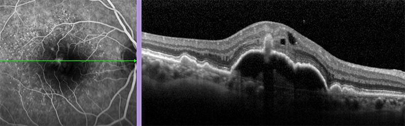 oct floresein anjiografi retinal anjiomatöz proliferasyon