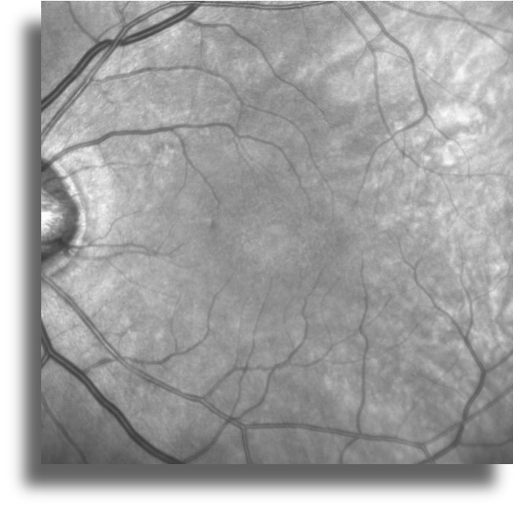 Non-Neoplastik Otoimmün Retinopati infrared reflektans