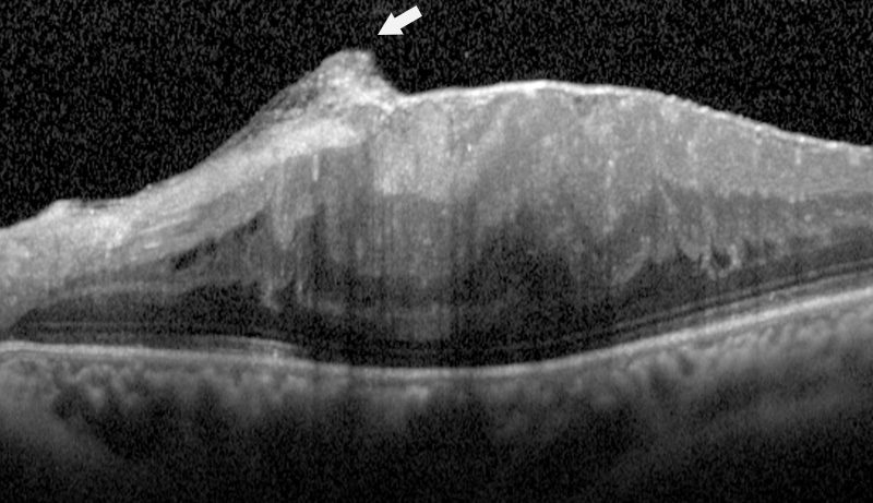 oct epiretinal membran fibriler sinir lifi tabakası defekti