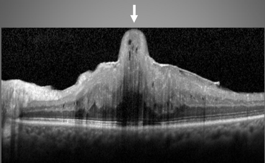 oct epiretinal membran foveal herniasyon