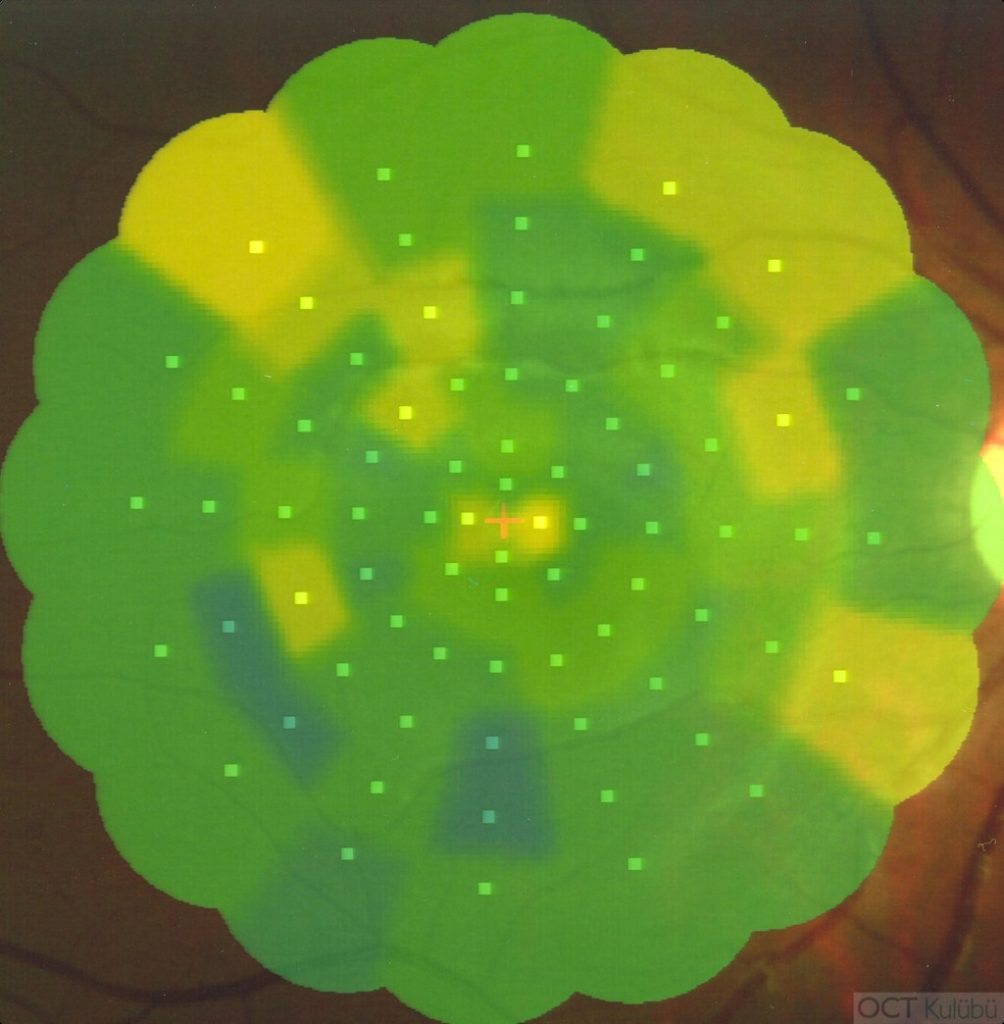 Okült Maküler Distrofi
Mikroperimetri