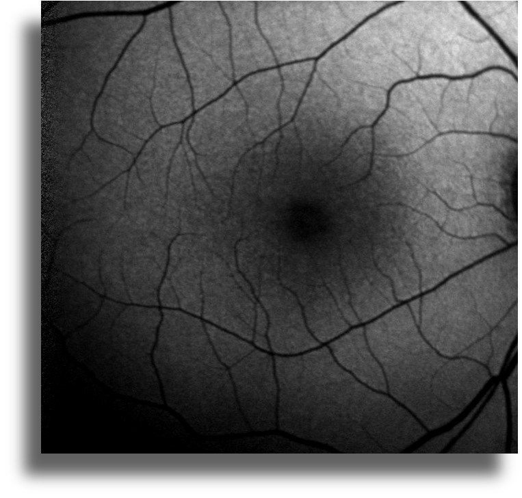 Non-Neoplastik Otoimmün Retinopati fundus otoflöresans