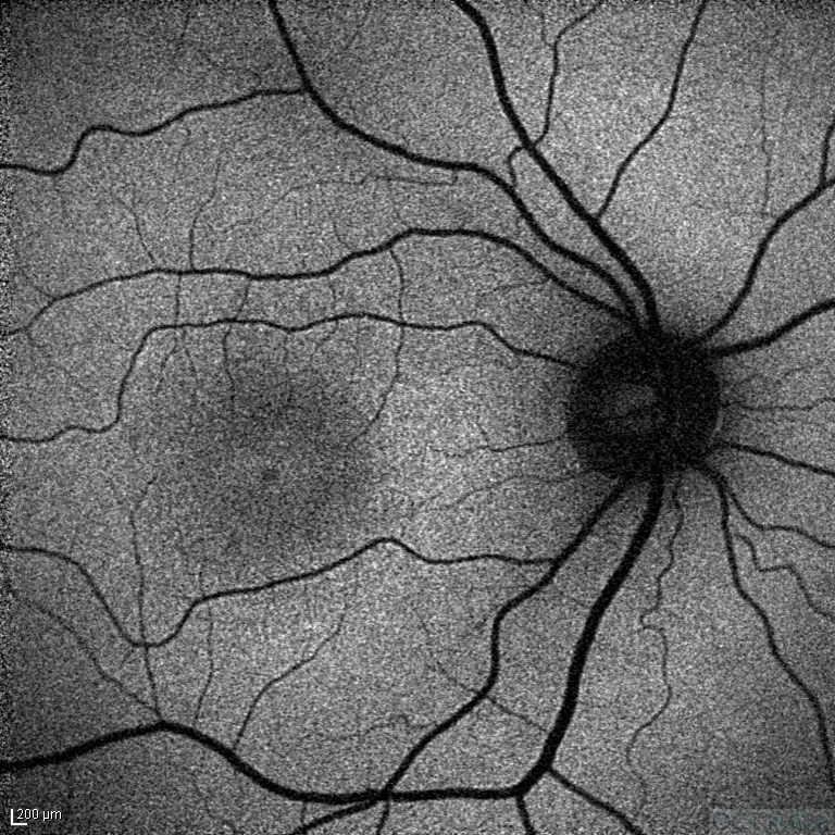 Okült Maküler Distrofi
Fundus Otoflöresans