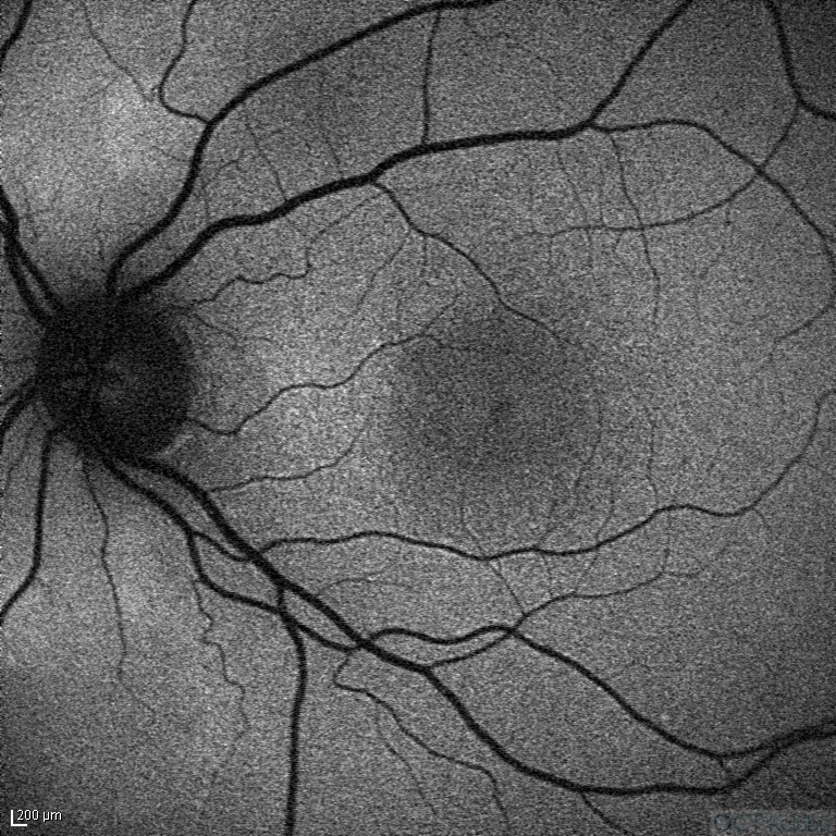 Okült Maküler Distrofi
Fundus Otoflöresans