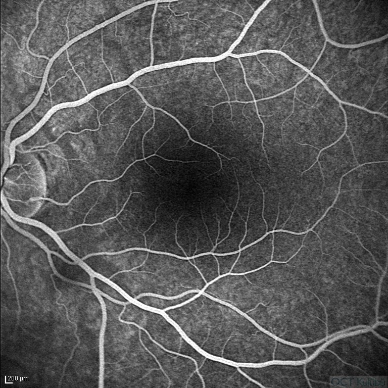 Okült Maküler Distrofi
Flöresein Anjiografi
