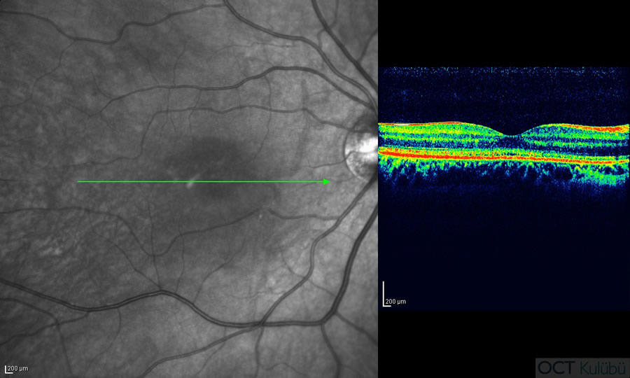 Okült Maküler Distrofi
Optik Koherens Tomografi
