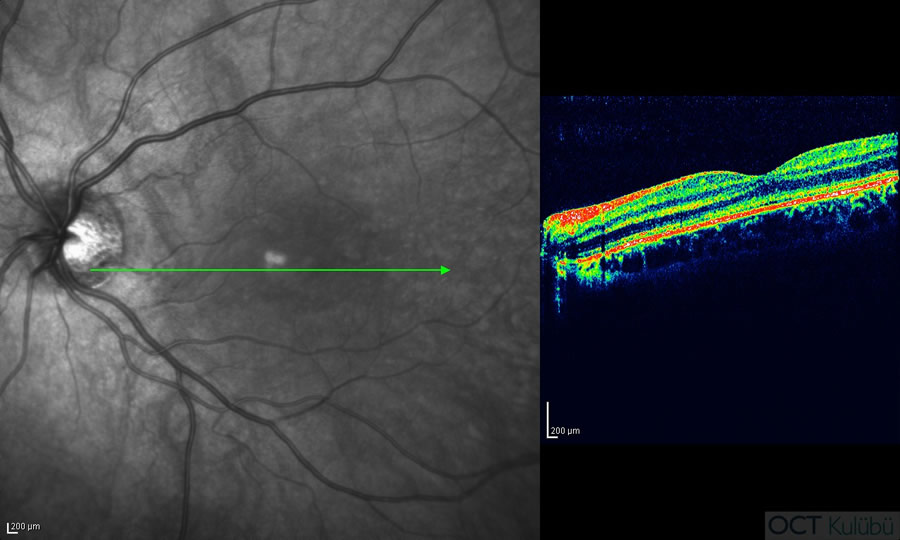 Okült Maküler Distrofi
Optik Koherens Tomografi
