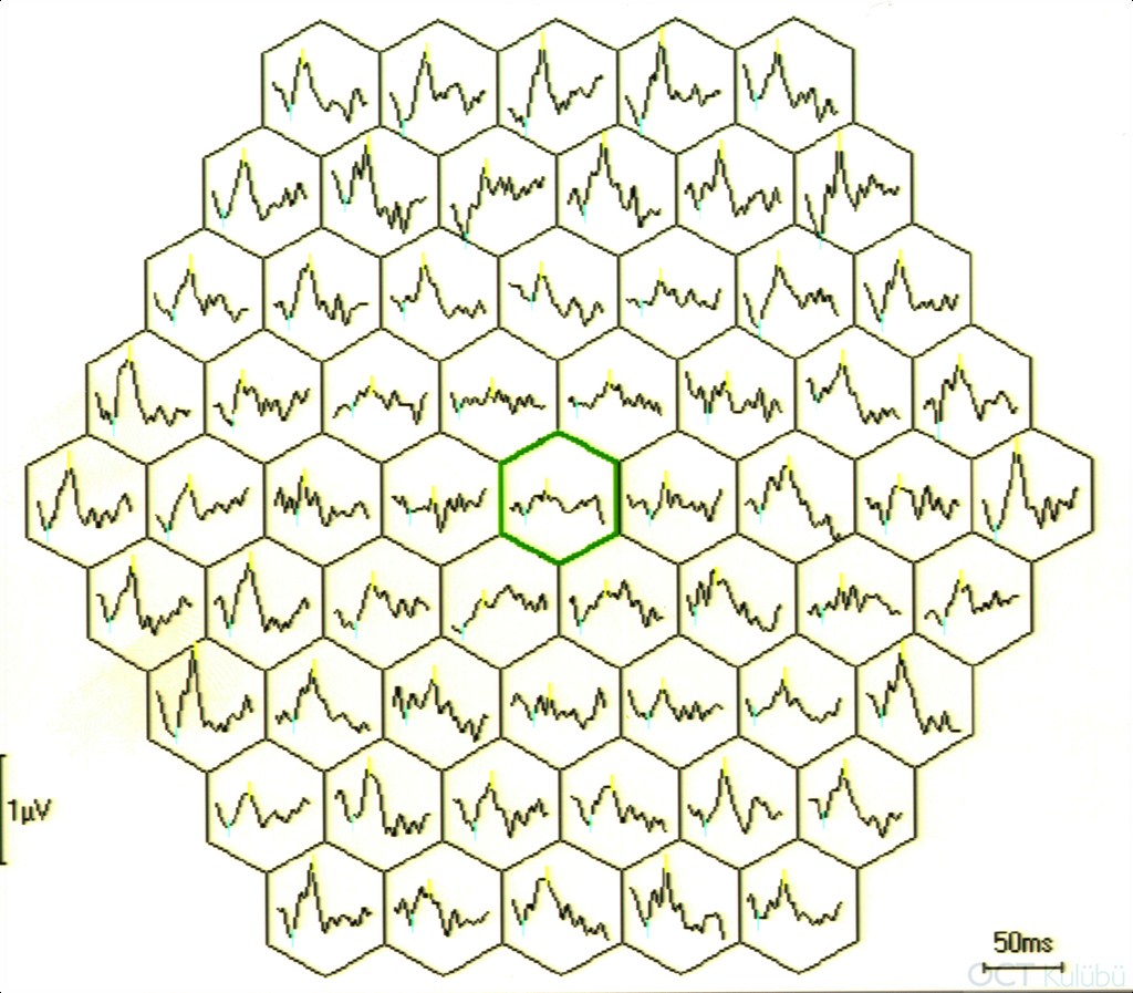 Okült Maküler Distrofi
Multifokal ERG
