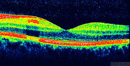 oct normal retina