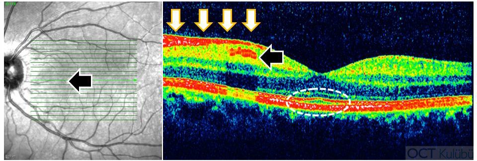 oct normal retina