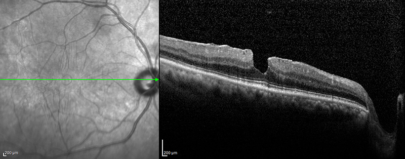 oct makuler pseudohole