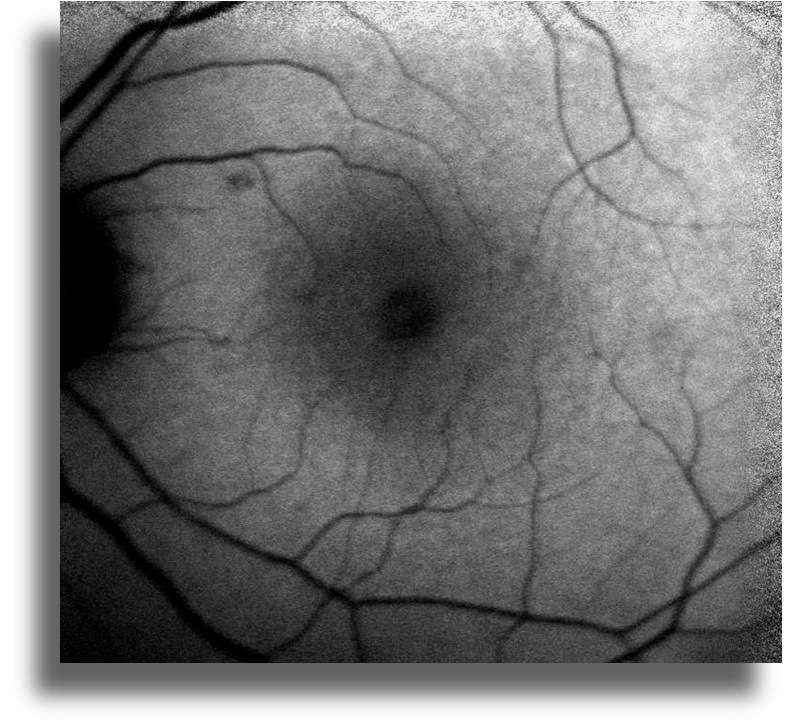 Non-Neoplastik Otoimmün Retinopati fundus otoflöresans