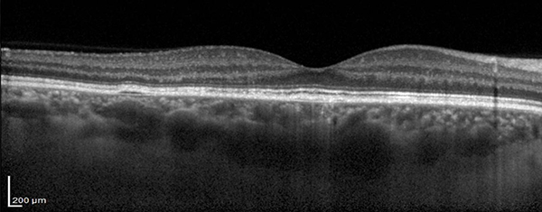 oct santral seröz koryoretinopati