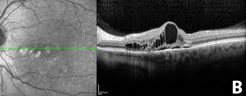 oct santral seröz koryoretinopati