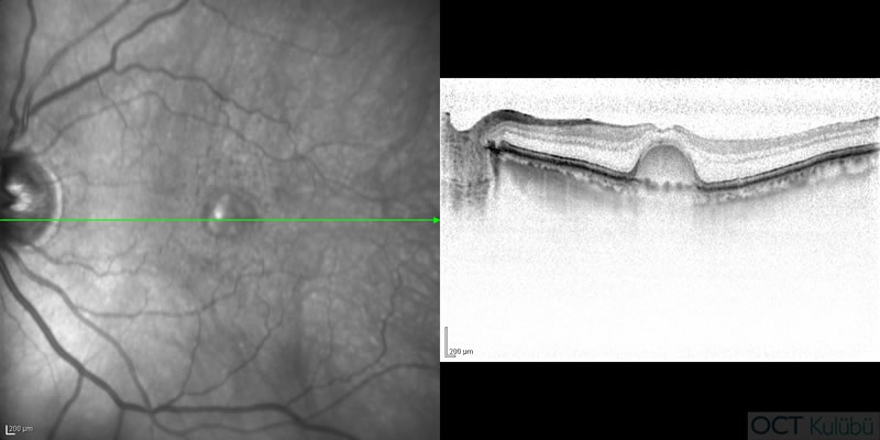 oct erişkin tip vitelliform distrofi