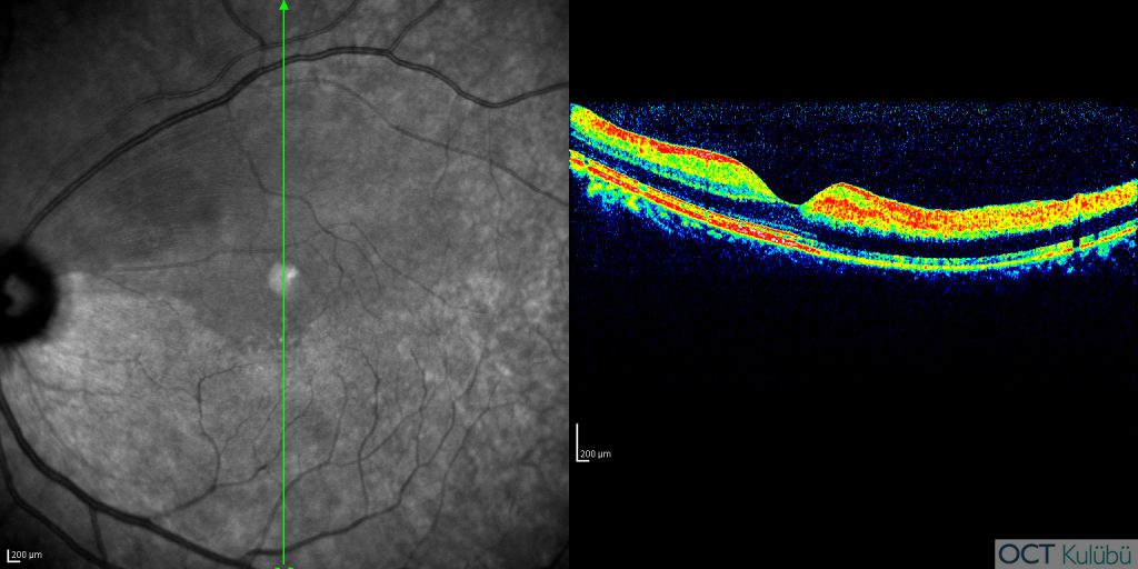 oct retinal artel dal tıkanıklığı