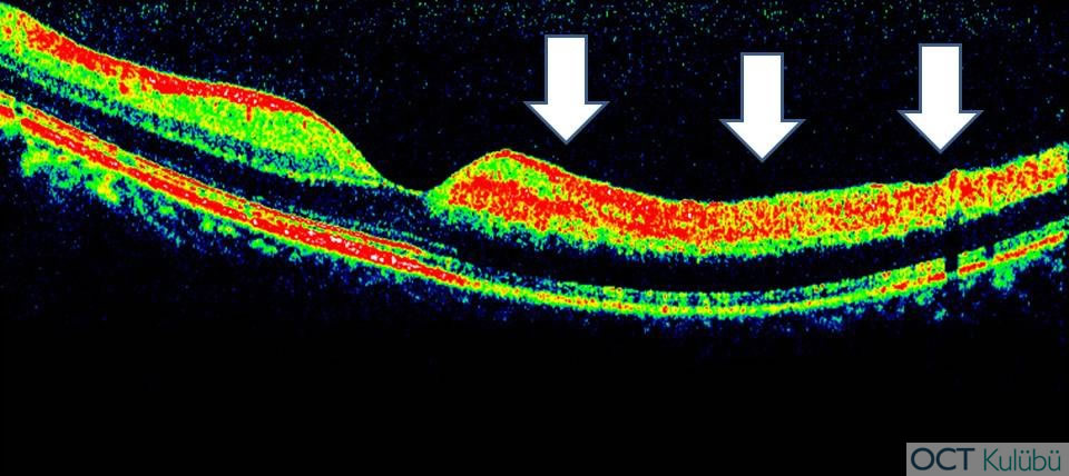 oct retinal arter dal tıkanıklığı