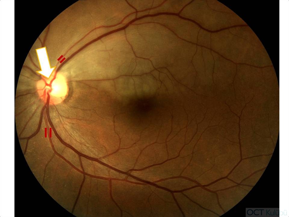 renkli fundus resmi retinal arter dal tıkanıklığı