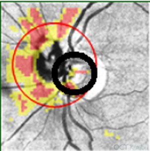 OCT Çekim Hatası
Retina sinir lifi kalınlığı