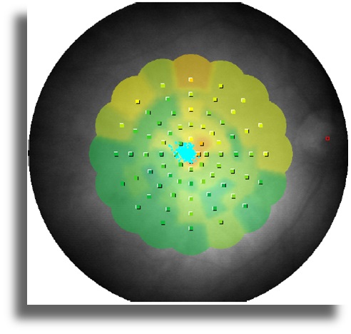 Non-Neoplastik Otoimmün Retinopati  mikroperimetri