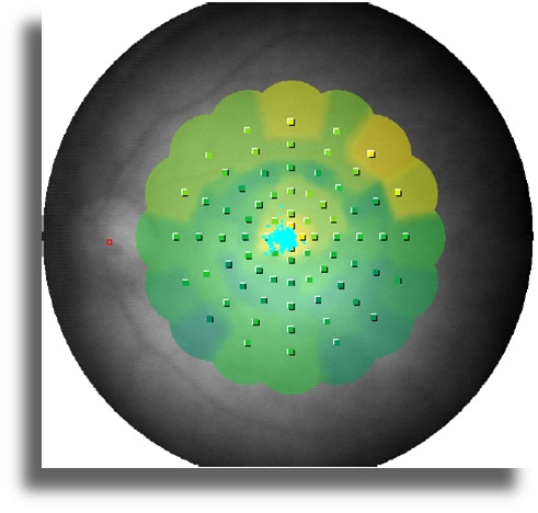 Non-Neoplastik Otoimmün Retinopati  mikroperimetri