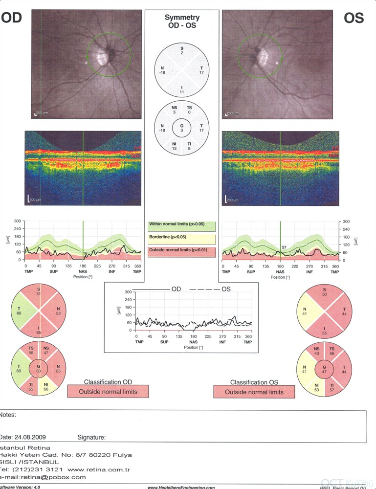 Tilted Disk Sendromu
Optik koherens tomografi 
Retina sinir lifi kalınlığı