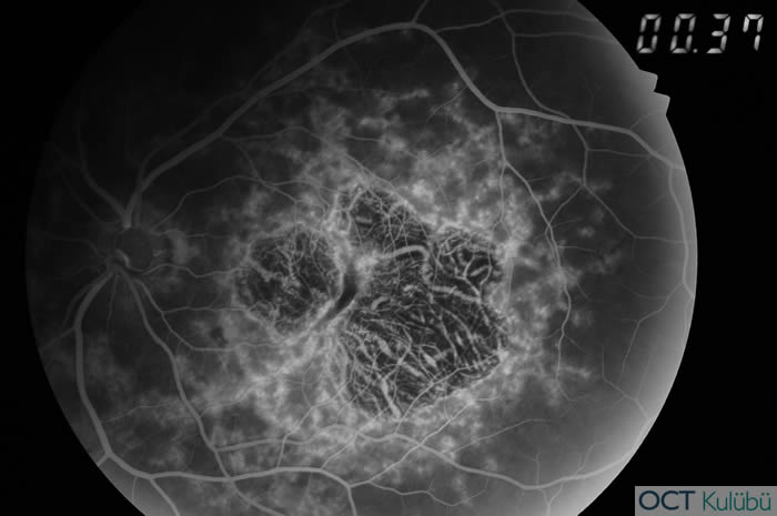 Fundus Flavimakulatus
Flöresein anjiografi