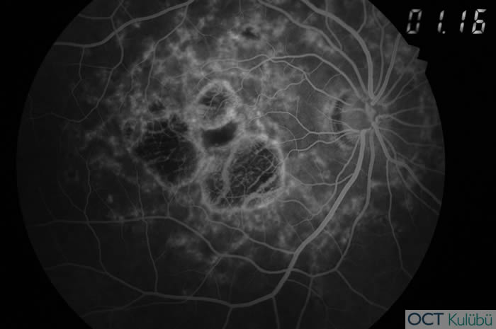 Fundus Flavimakulatus
Flöresein anjiografi