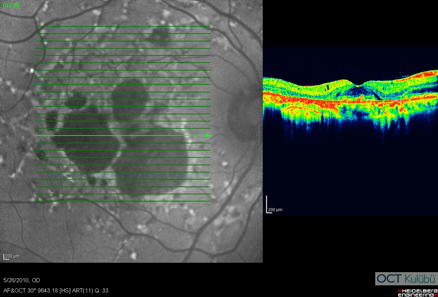 Fundus Flavimakulatus
Optik koherens tomografi