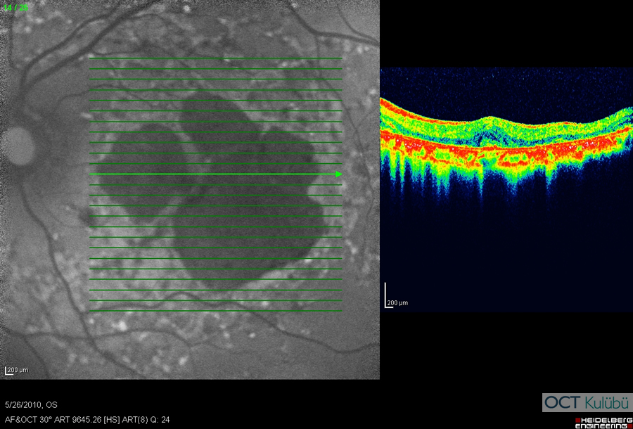 Fundus Flavimakulatus
Optik koherens tomografi