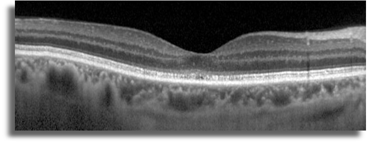 Non-Neoplastik Otoimmün Retinopati  OCT